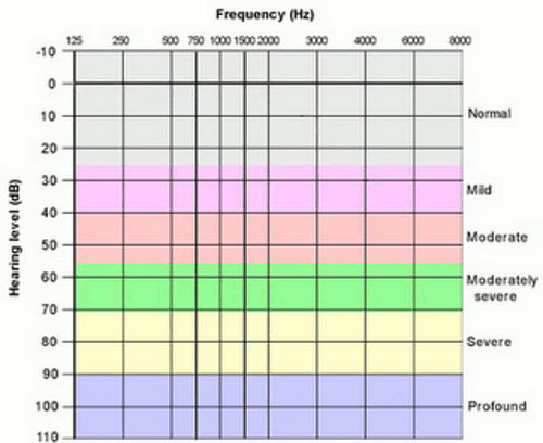 ClinicalAudiogram.gif