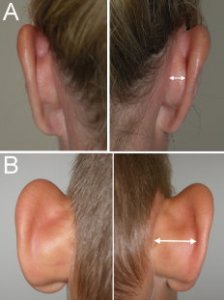 Ytre_ore_A_Normal ear cartilage patient_B_Excess cartilage growth contributing to protruding e...jpg