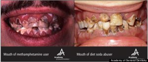 r-DIET-SODA-TEETH-large570.jpg