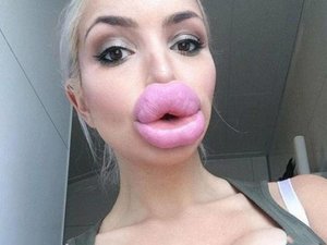 weird-huge-fake-lips-fillers-pic.jpg